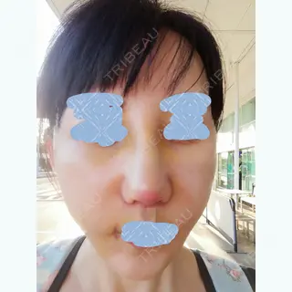 6日目の経過画像（1枚目）