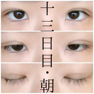 13日目の経過画像（1枚目）