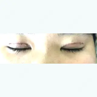 12日目の経過画像（2枚目）