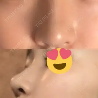 34日目の経過画像（1枚目）