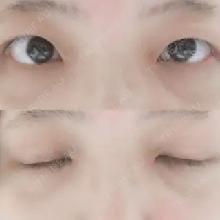 14日目の経過画像（1枚目）