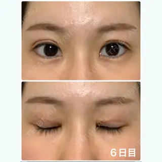 6日目の経過画像（1枚目）