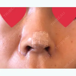 1日目の経過画像（1枚目）