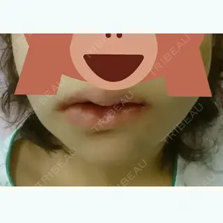 0日目の経過画像（2枚目）