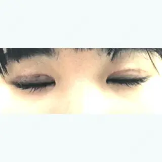 13日目の経過画像（2枚目）
