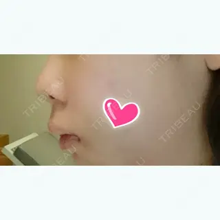 2日目の経過画像（2枚目）