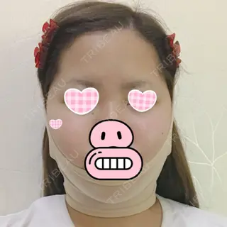 1日目の経過画像（1枚目）
