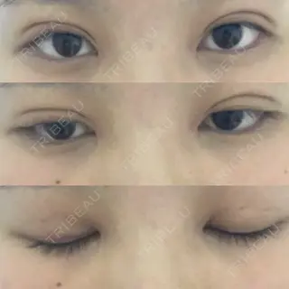 15日目の経過画像（1枚目）