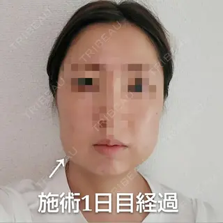 1日目の経過画像（1枚目）