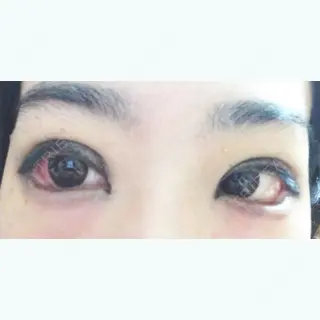 14日目の経過画像（2枚目）