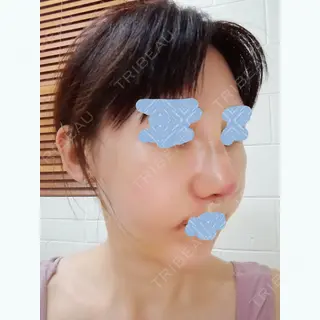 8日目の経過画像（2枚目）