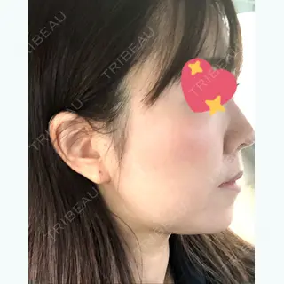 31日目の経過画像（2枚目）