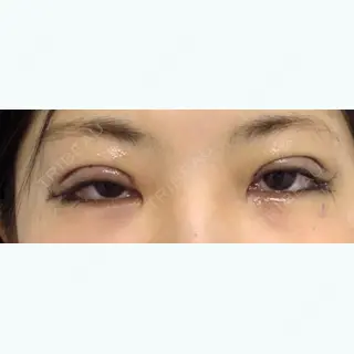 0日目の経過画像（1枚目）
