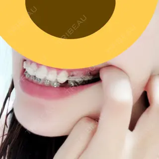 86日目の経過画像（2枚目）