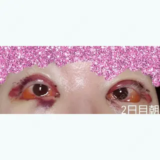 2日目の経過画像（1枚目）
