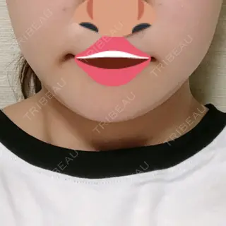 84日目の経過画像（1枚目）