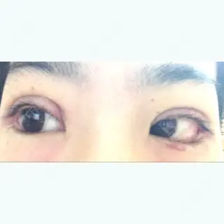 14日目の経過画像（1枚目）