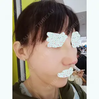 10日目の経過画像（2枚目）