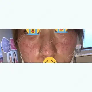 0日目の経過画像（2枚目）