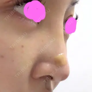 7日目の経過画像（3枚目）
