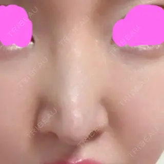 10日目の経過画像（2枚目）