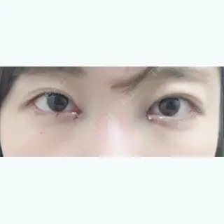 0日目の経過画像（1枚目）