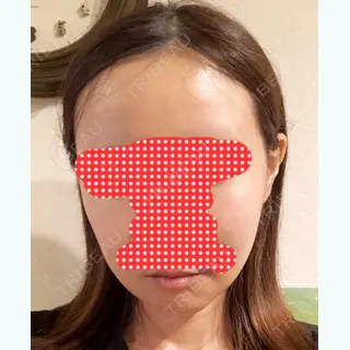 17日目の経過画像（1枚目）