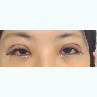 1日目の経過画像（1枚目）