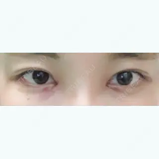 2日目の経過画像（1枚目）
