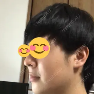 30日目の経過画像（3枚目）