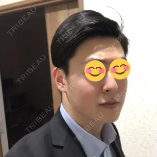 90日目の経過画像（2枚目）