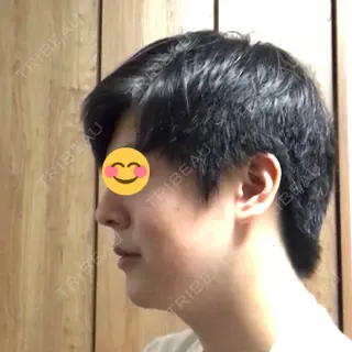 176日目の経過画像（3枚目）