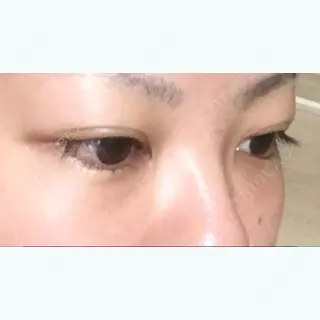64日目の経過画像（3枚目）