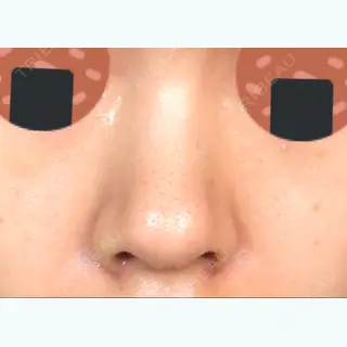 12日目の経過画像（1枚目）