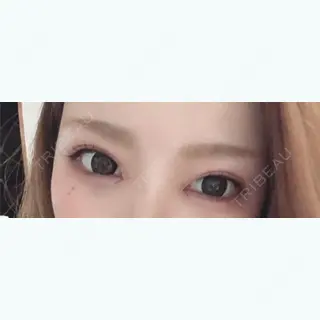 3日目の経過画像（2枚目）