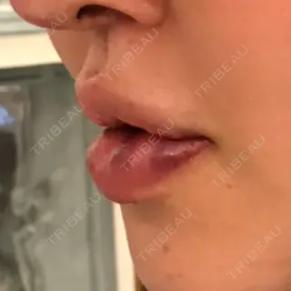 1日目の経過画像（3枚目）