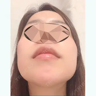 122日目の経過画像（2枚目）