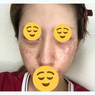 3日目の経過画像（3枚目）
