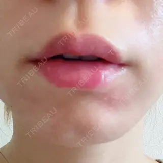 5日目の経過画像（1枚目）