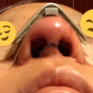 0日目の経過画像（2枚目）
