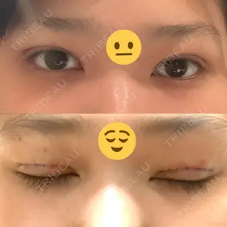 0日目の経過画像（1枚目）