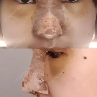 4日目の経過画像（1枚目）