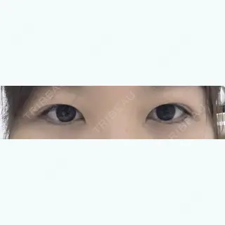 37日目の経過画像（1枚目）