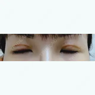 5日目の経過画像（2枚目）