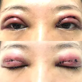 1日目の経過画像（1枚目）