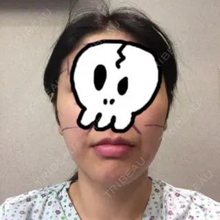 0日目の経過画像（1枚目）