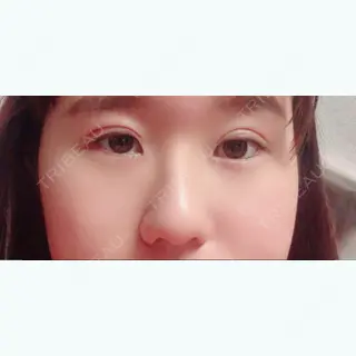 0日目の経過画像（1枚目）