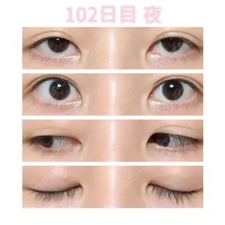 102日目の経過画像（2枚目）