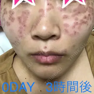 0日目の経過画像（1枚目）
