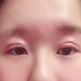 1日目の経過画像（1枚目）